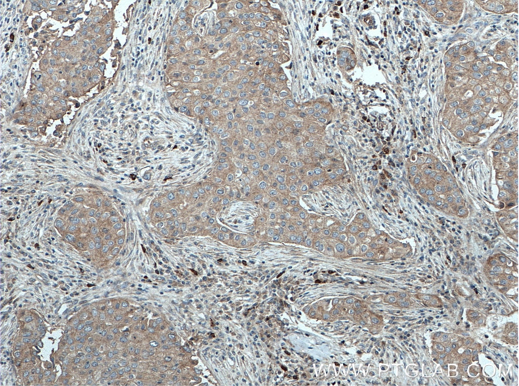 Immunohistochemistry (IHC) staining of human breast cancer tissue using DHX58/LGP2 Polyclonal antibody (11355-1-AP)