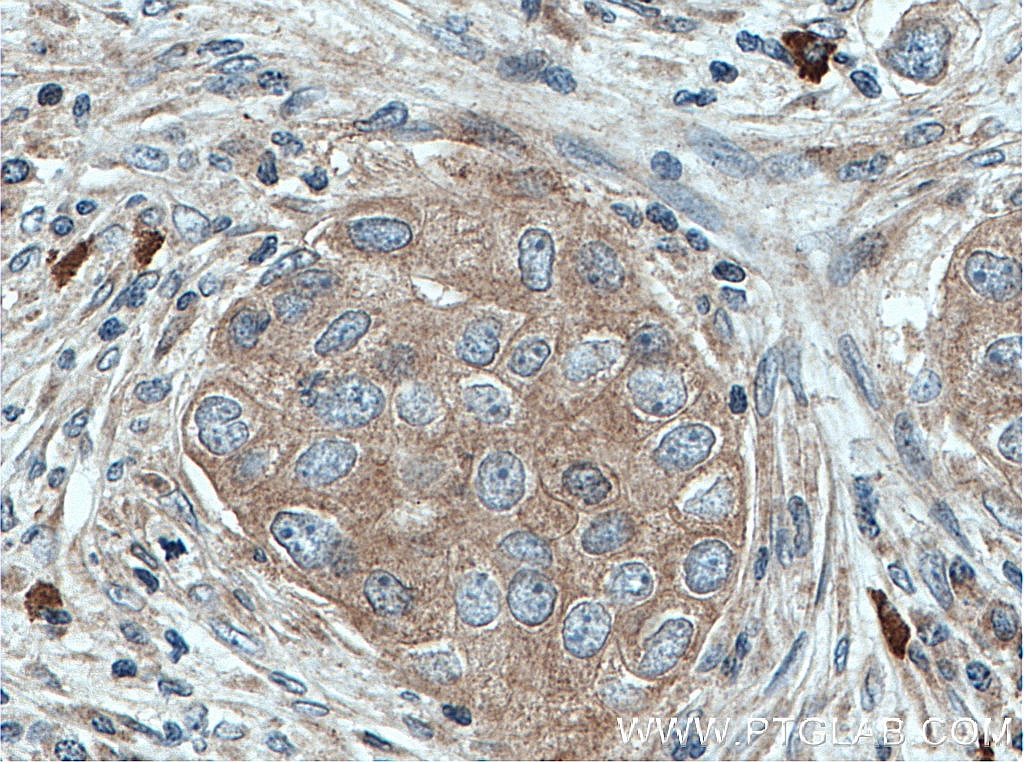 Immunohistochemistry (IHC) staining of human breast cancer tissue using DHX58/LGP2 Polyclonal antibody (11355-1-AP)