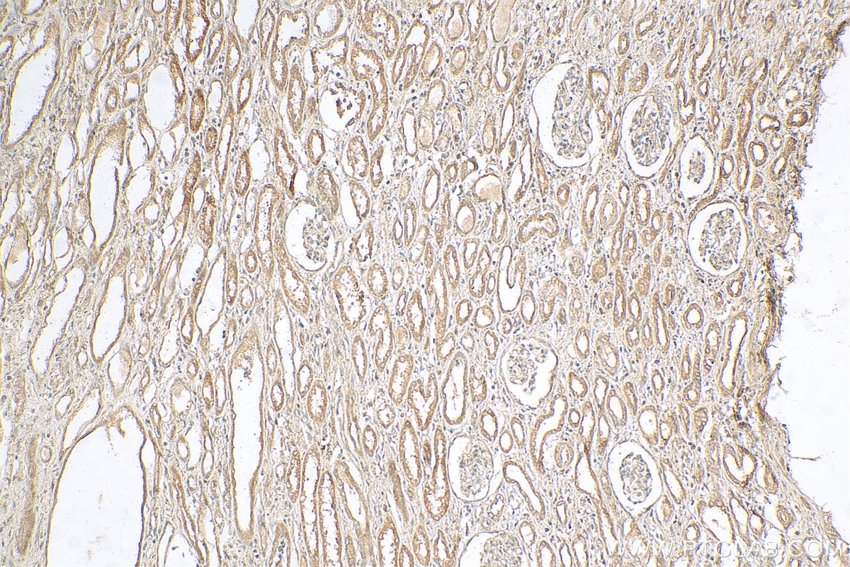 Immunohistochemistry (IHC) staining of human nephroblastoma tissue using DHX58/LGP2 Polyclonal antibody (11355-1-AP)