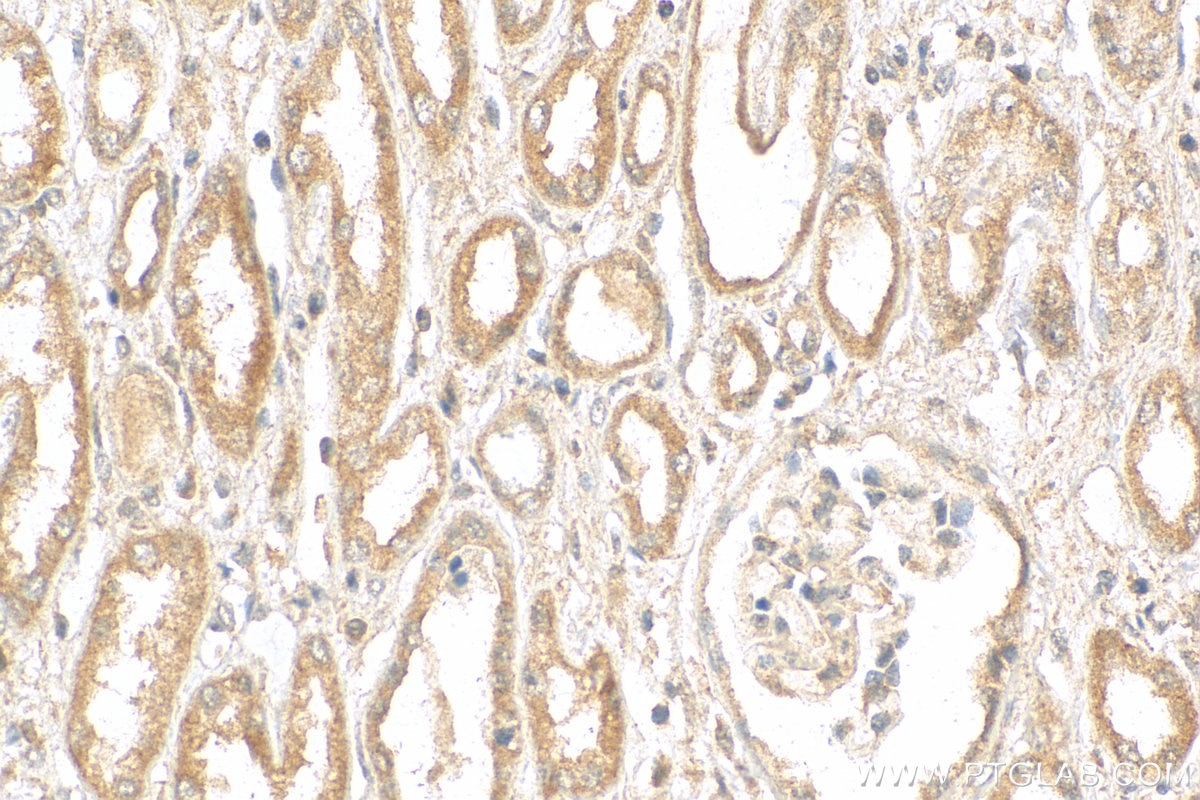 Immunohistochemistry (IHC) staining of human nephroblastoma tissue using DHX58/LGP2 Polyclonal antibody (11355-1-AP)
