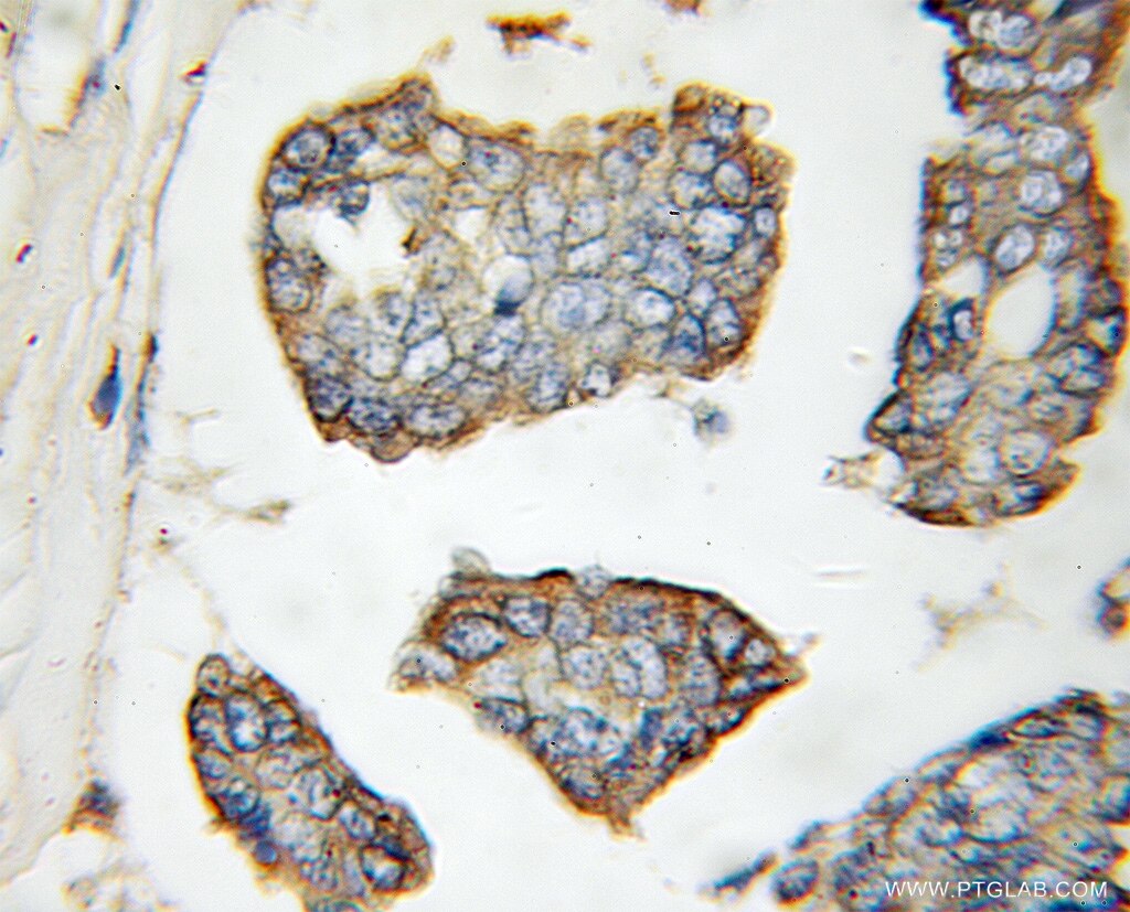 IHC staining of human breast cancer using 11355-1-AP