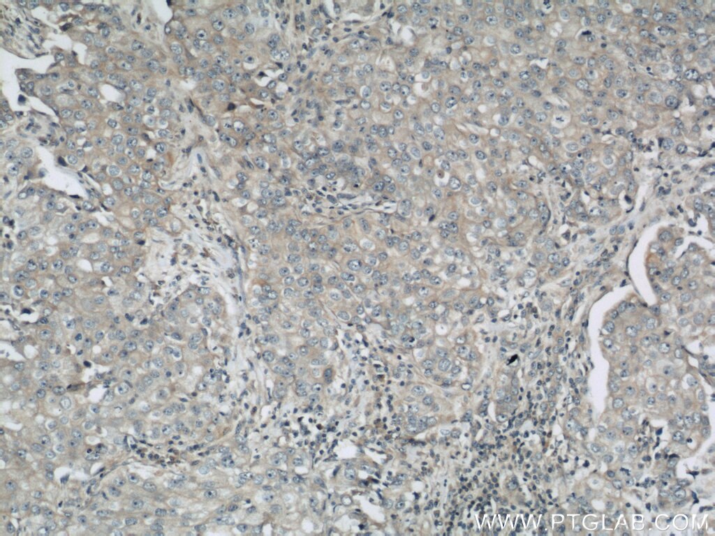 Immunohistochemistry (IHC) staining of human breast cancer tissue using DHX58/LGP2 Polyclonal antibody (11355-1-AP)