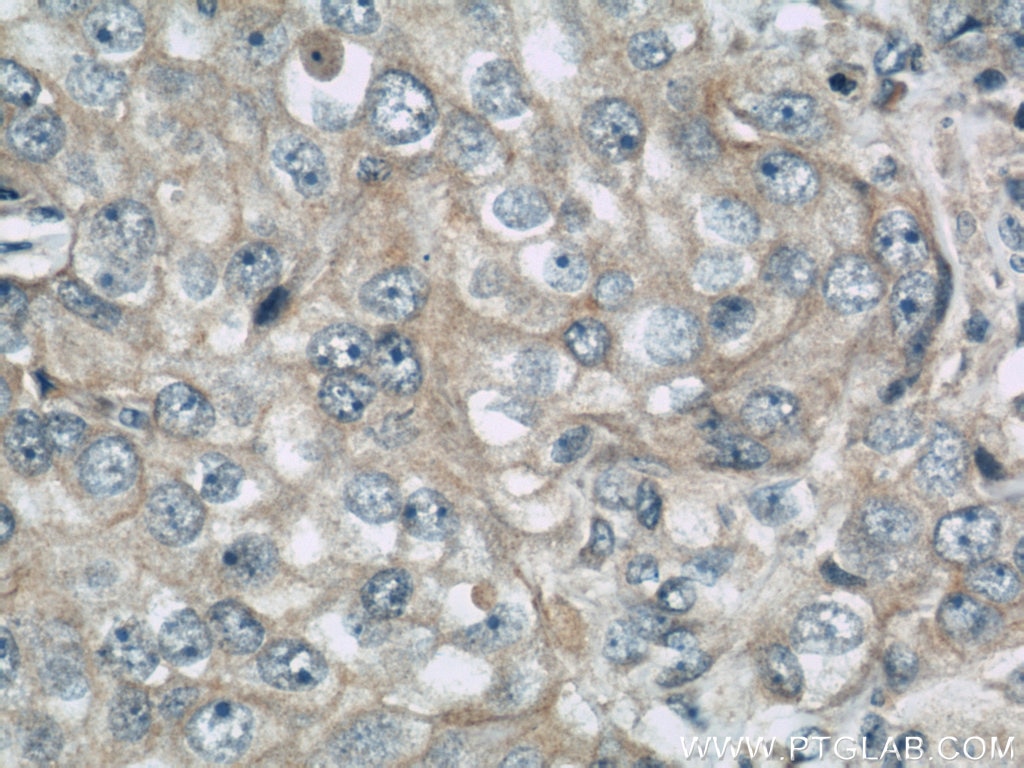 Immunohistochemistry (IHC) staining of human breast cancer tissue using DHX58/LGP2 Polyclonal antibody (11355-1-AP)