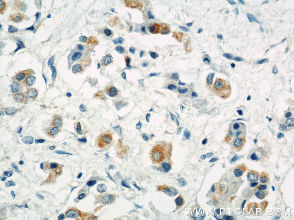IHC staining of human breast cancer using 11355-1-AP