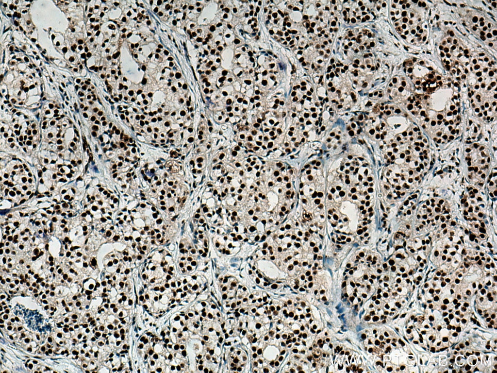 Immunohistochemistry (IHC) staining of human breast cancer tissue using DHX9 Monoclonal antibody (67153-1-Ig)