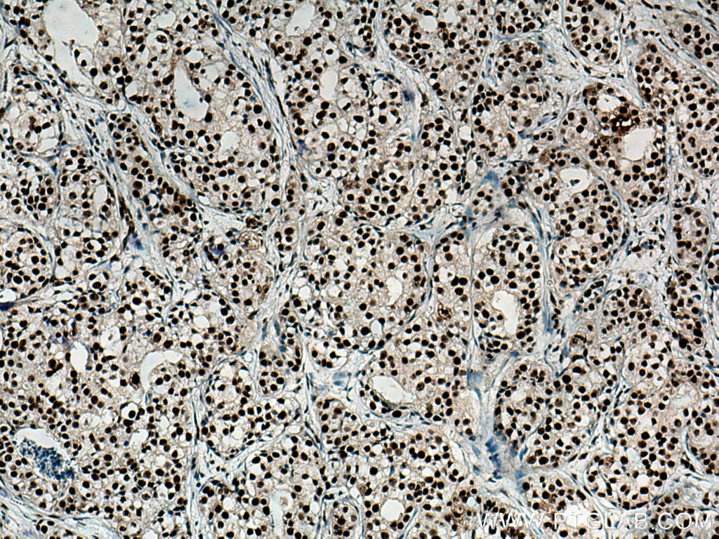 IHC staining of human breast cancer using 67153-1-Ig