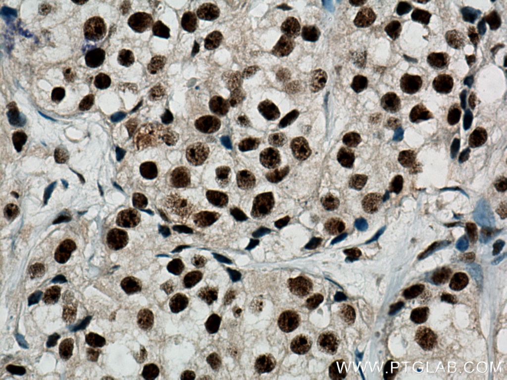 IHC staining of human breast cancer using 67153-1-Ig