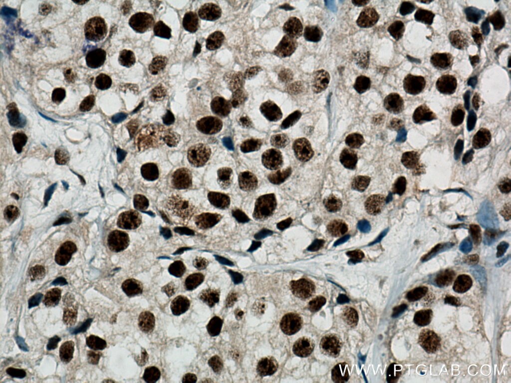 Immunohistochemistry (IHC) staining of human breast cancer tissue using DHX9 Monoclonal antibody (67153-1-Ig)