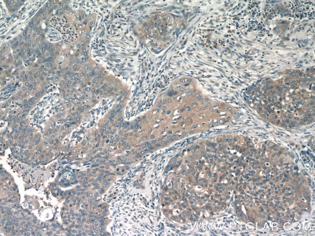 Immunohistochemistry (IHC) staining of human cervical cancer tissue using DIAPH3 Polyclonal antibody (14342-1-AP)