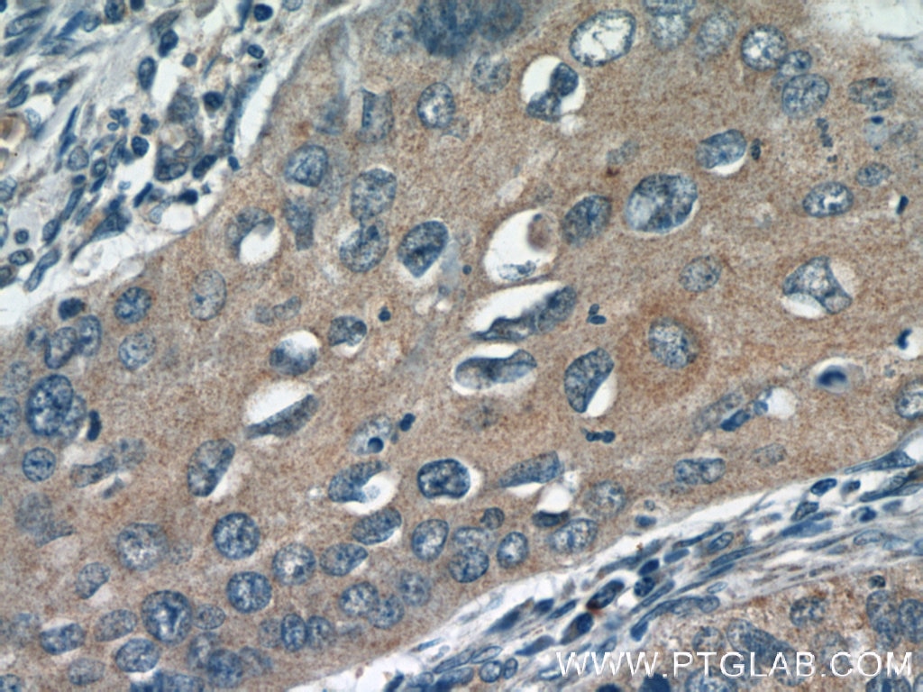 Immunohistochemistry (IHC) staining of human cervical cancer tissue using DIAPH3 Polyclonal antibody (14342-1-AP)