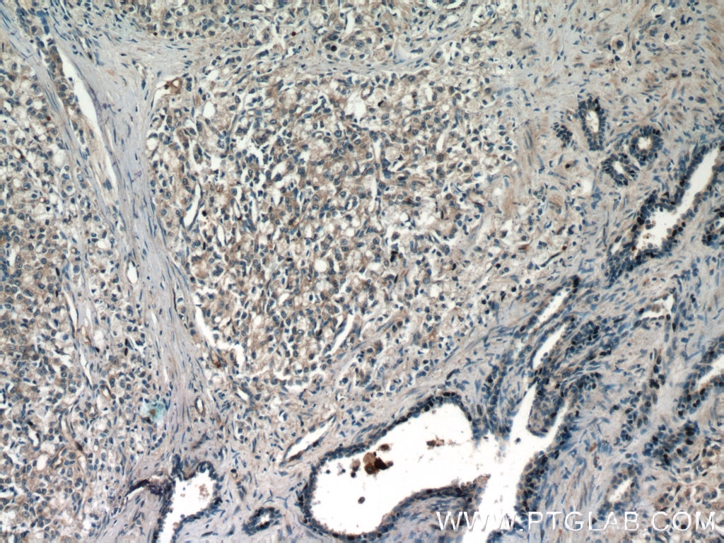 Immunohistochemistry (IHC) staining of human prostate cancer tissue using DIAPH3 Polyclonal antibody (14342-1-AP)