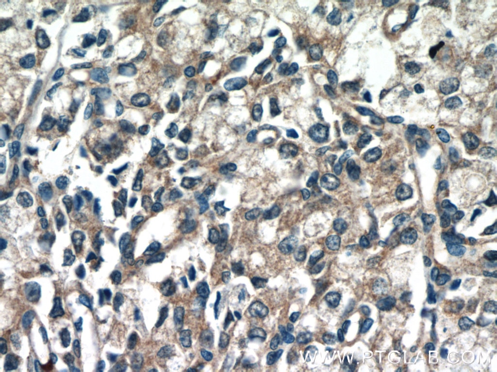 Immunohistochemistry (IHC) staining of human prostate cancer tissue using DIAPH3 Polyclonal antibody (14342-1-AP)