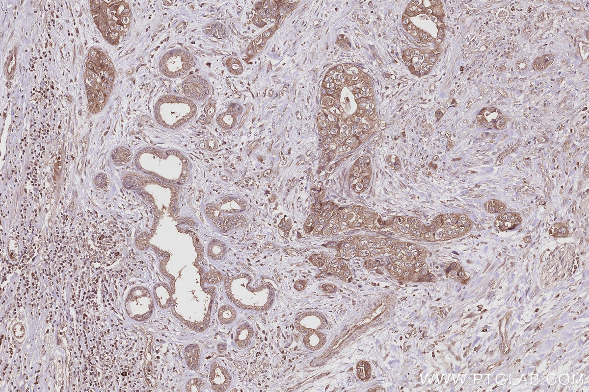 Immunohistochemistry (IHC) staining of human pancreas cancer tissue using DIAPH3 Polyclonal antibody (14342-1-AP)