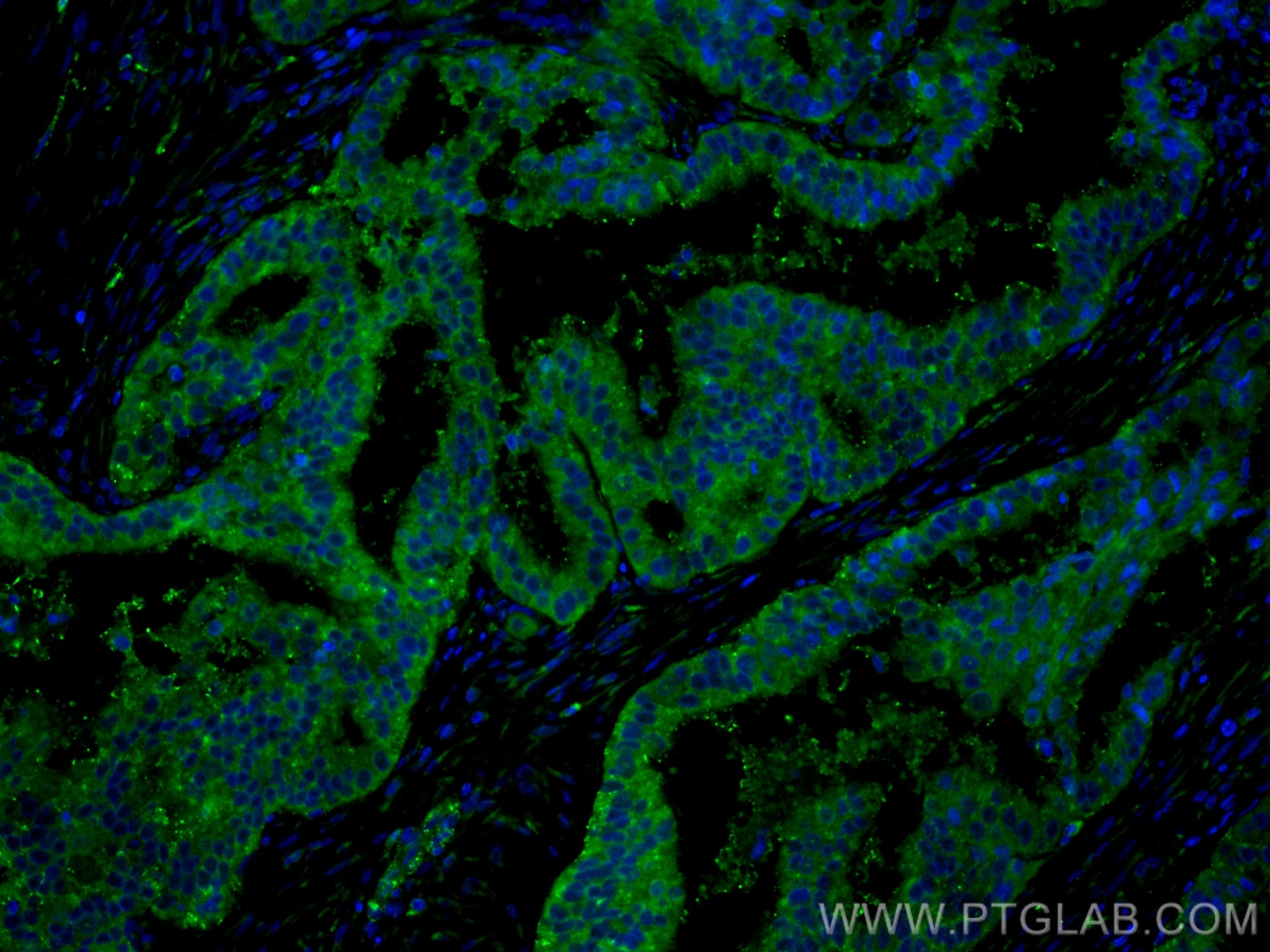 Immunofluorescence (IF) / fluorescent staining of human ovary tumor tissue using DICER1 Polyclonal antibody (20567-1-AP)