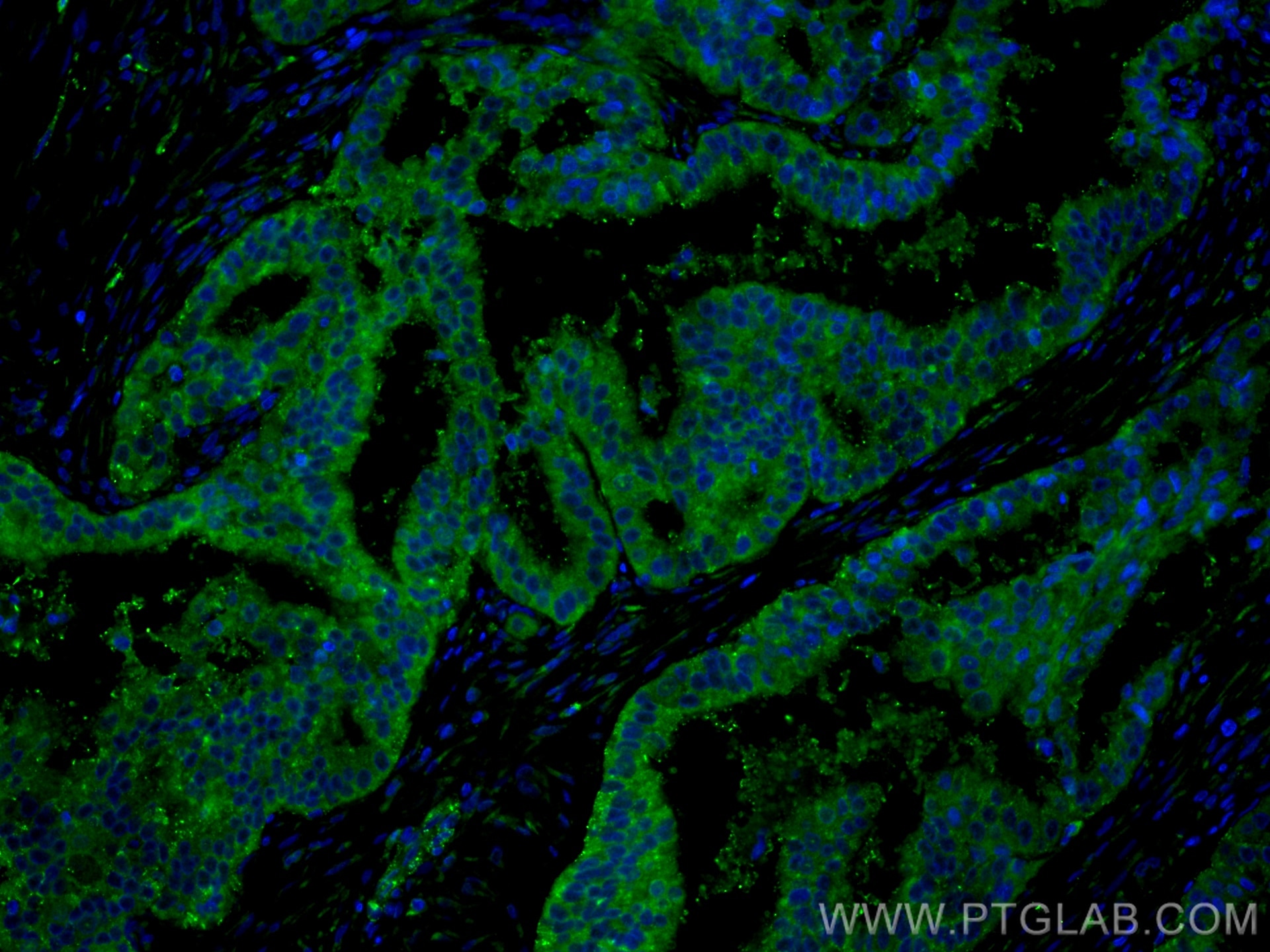 IF Staining of human ovary tumor using 20567-1-AP