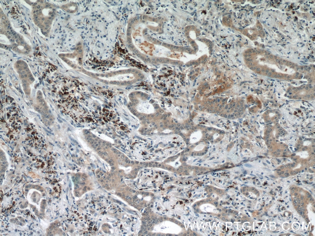 Immunohistochemistry (IHC) staining of human lung cancer tissue using DICER1 Polyclonal antibody (20567-1-AP)