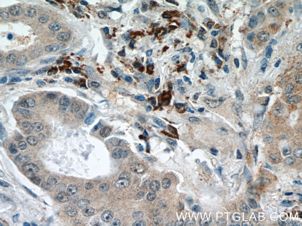 Immunohistochemistry (IHC) staining of human lung cancer tissue using DICER1 Polyclonal antibody (20567-1-AP)
