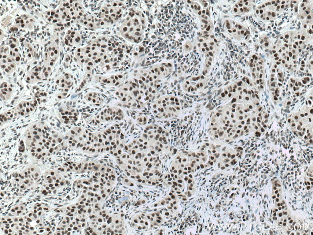 Immunohistochemistry (IHC) staining of human breast cancer tissue using DIDO1 Polyclonal antibody (10183-1-AP)