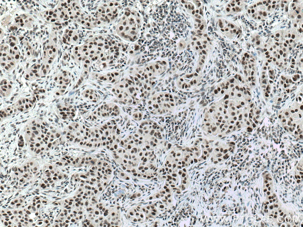 Immunohistochemistry (IHC) staining of human breast cancer tissue using DIDO1 Polyclonal antibody (10183-1-AP)