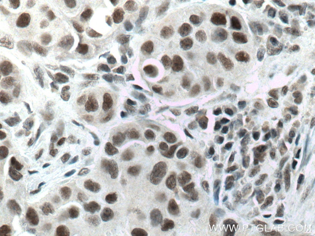 Immunohistochemistry (IHC) staining of human breast cancer tissue using DIDO1 Polyclonal antibody (10183-1-AP)