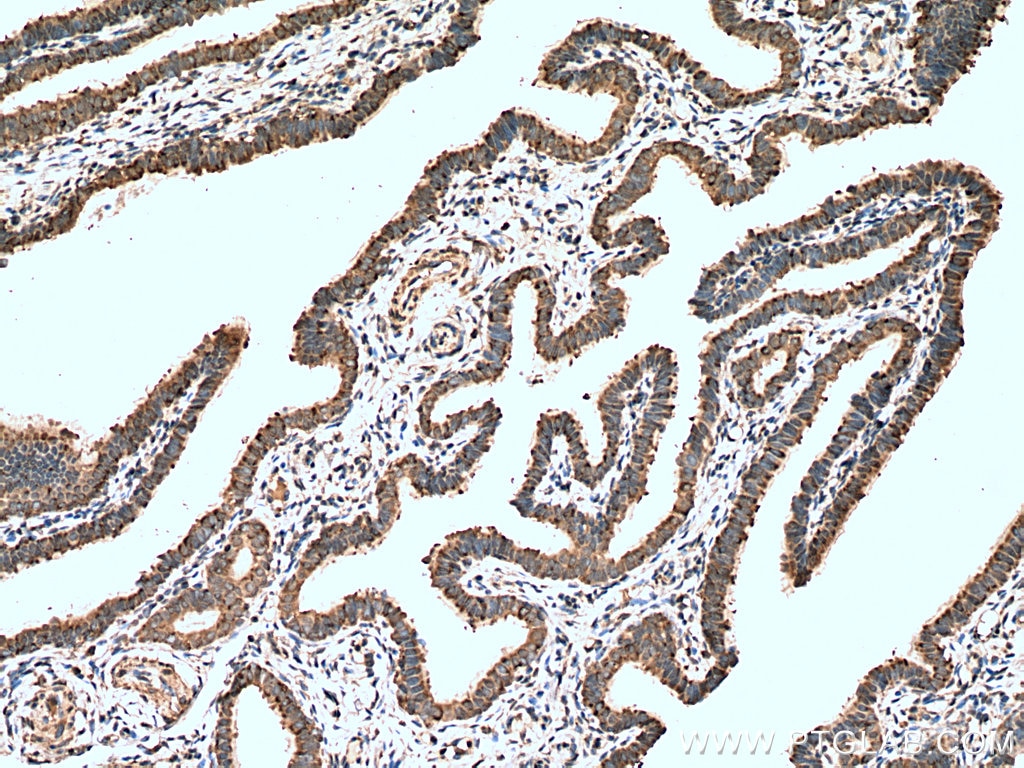 Immunohistochemistry (IHC) staining of human ovary tumor tissue using DIO1 Polyclonal antibody (11790-1-AP)