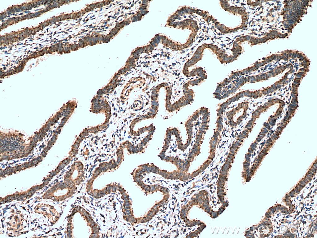 IHC staining of human ovary tumor using 11790-1-AP