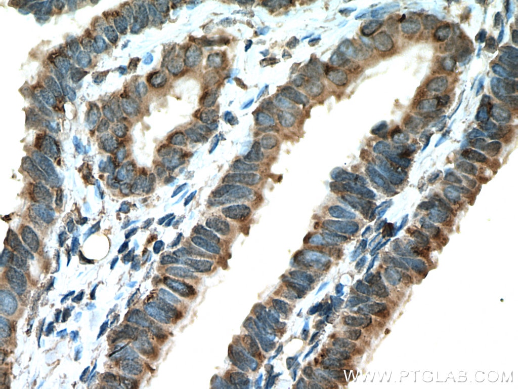 Immunohistochemistry (IHC) staining of human ovary tumor tissue using DIO1 Polyclonal antibody (11790-1-AP)