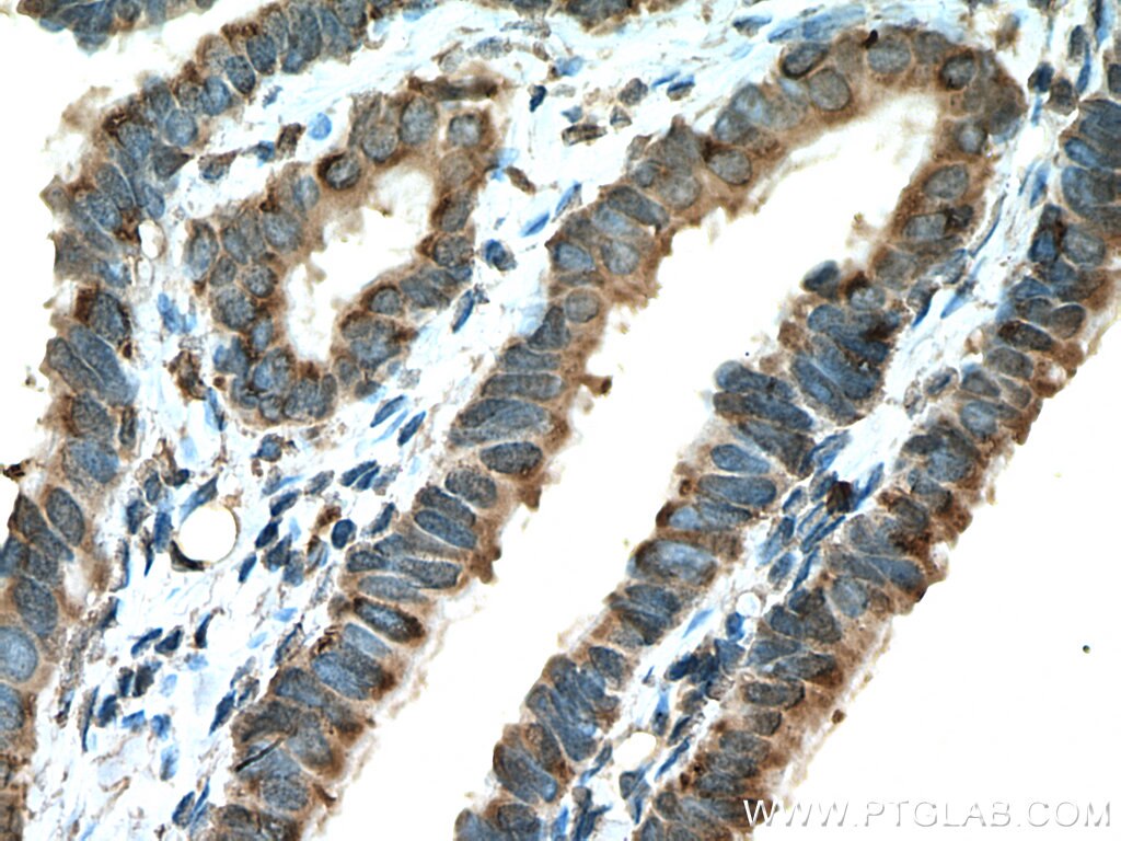 IHC staining of human ovary tumor using 11790-1-AP