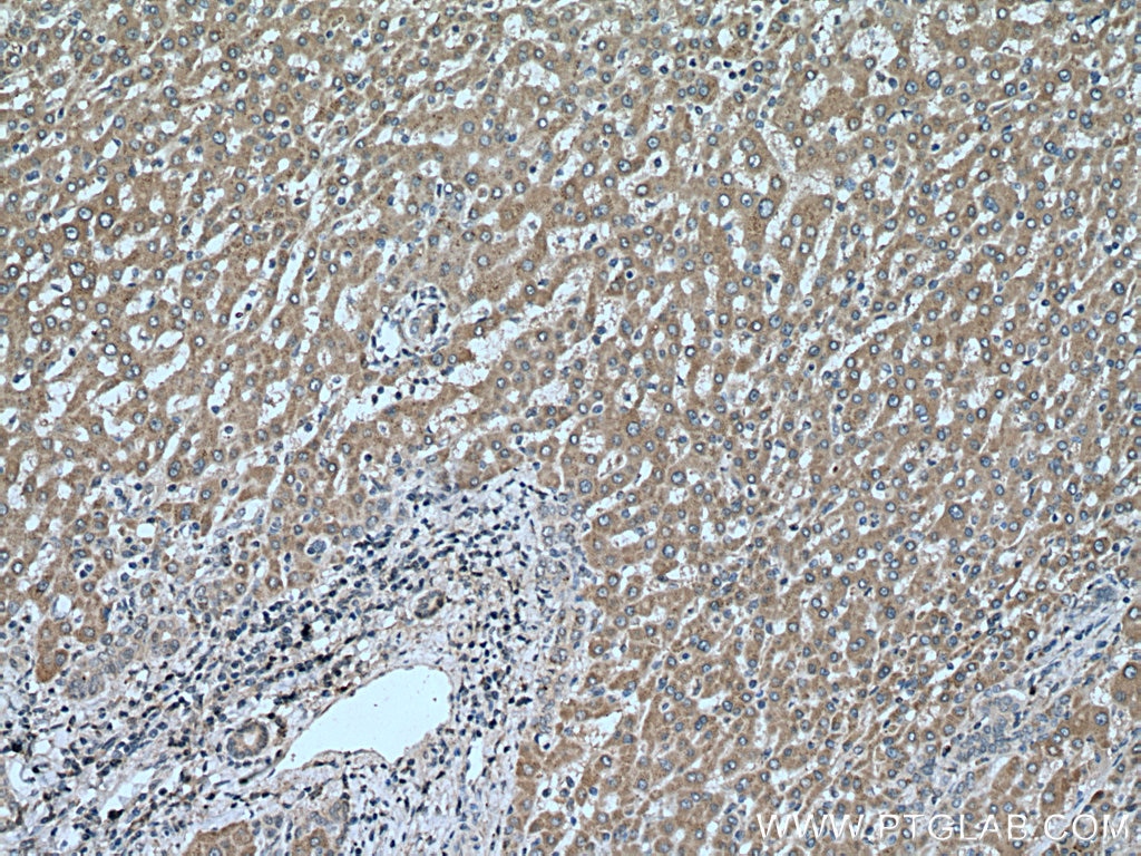 Immunohistochemistry (IHC) staining of human liver cancer tissue using DIO1 Polyclonal antibody (11790-1-AP)