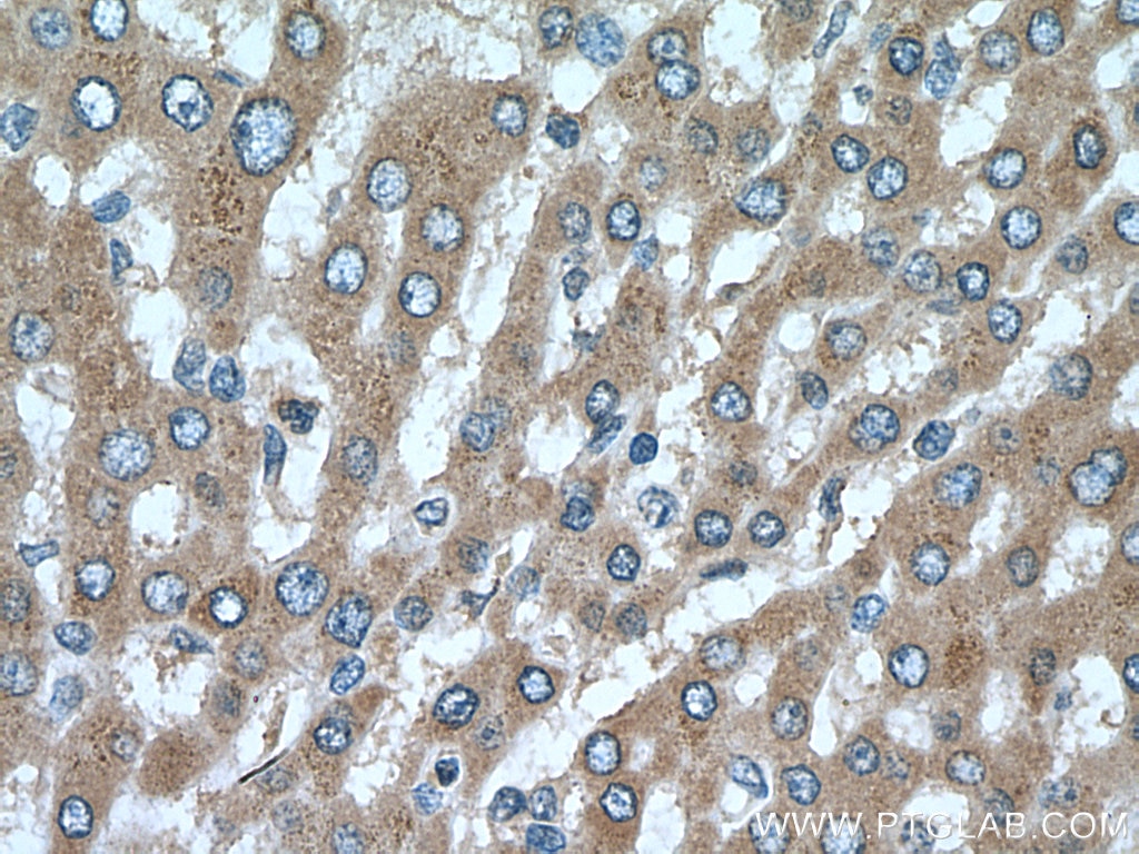 Immunohistochemistry (IHC) staining of human liver cancer tissue using DIO1 Polyclonal antibody (11790-1-AP)
