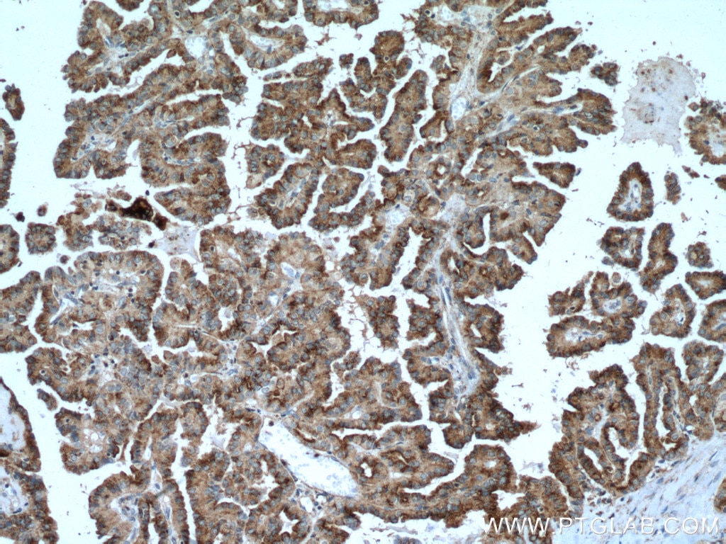 Immunohistochemistry (IHC) staining of human thyroid cancer tissue using DIO2 Monoclonal antibody (66813-1-Ig)