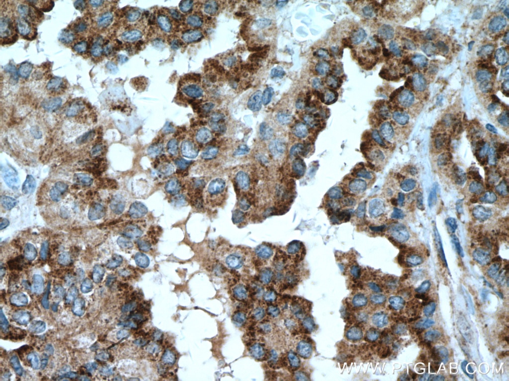 Immunohistochemistry (IHC) staining of human thyroid cancer tissue using DIO2 Monoclonal antibody (66813-1-Ig)