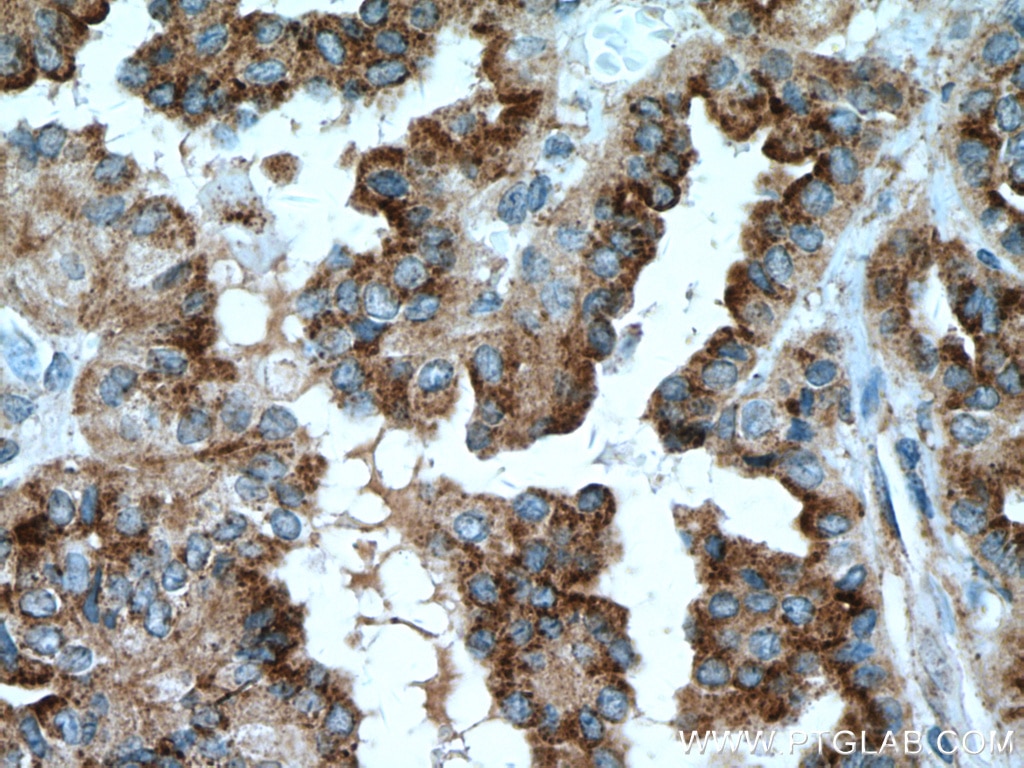 IHC staining of human thyroid cancer using 66813-1-Ig