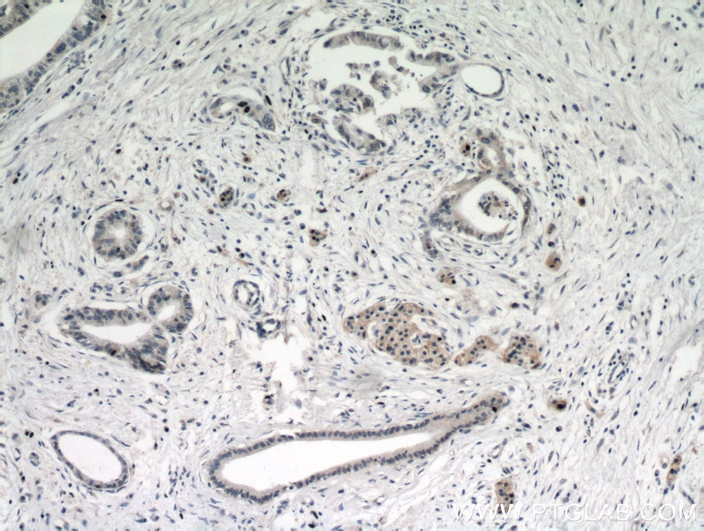 Immunohistochemistry (IHC) staining of human pancreas cancer tissue using ARHI Polyclonal antibody (10811-2-AP)