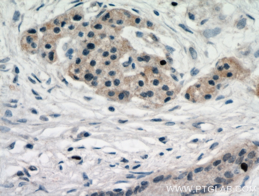 Immunohistochemistry (IHC) staining of human pancreas cancer tissue using ARHI Polyclonal antibody (10811-2-AP)