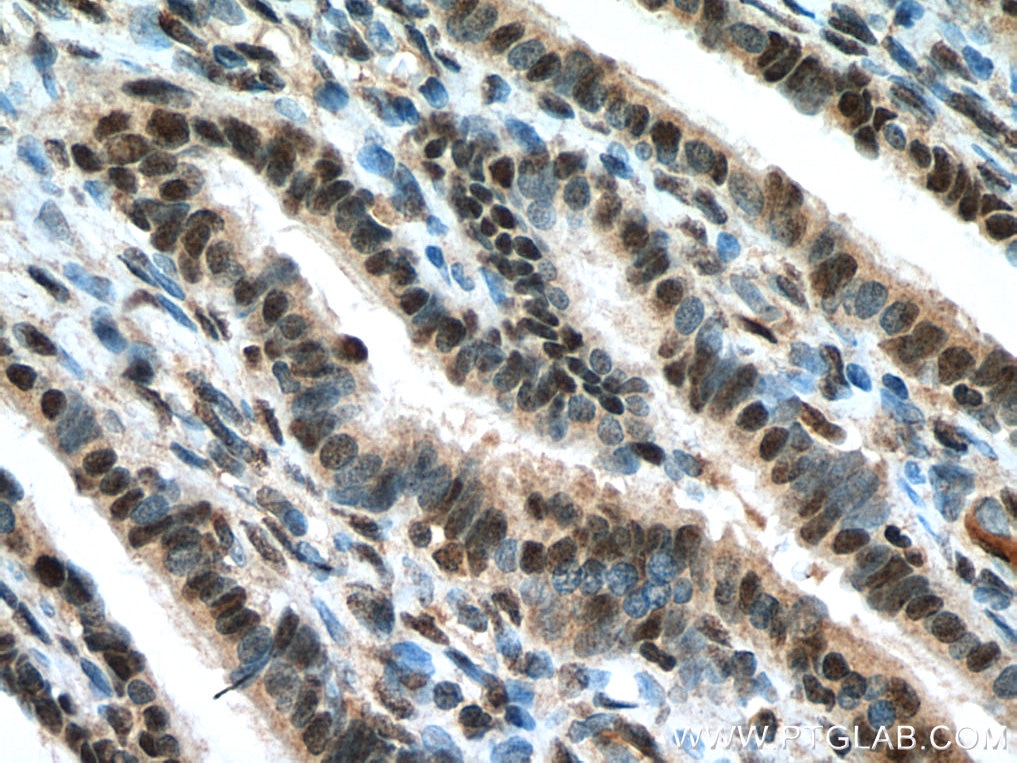 Immunohistochemistry (IHC) staining of human ovary tumor tissue using DIS3 Polyclonal antibody (14689-1-AP)