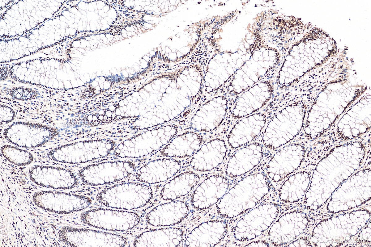 Immunohistochemistry (IHC) staining of human colon cancer tissue using DIS3 Polyclonal antibody (29664-1-AP)