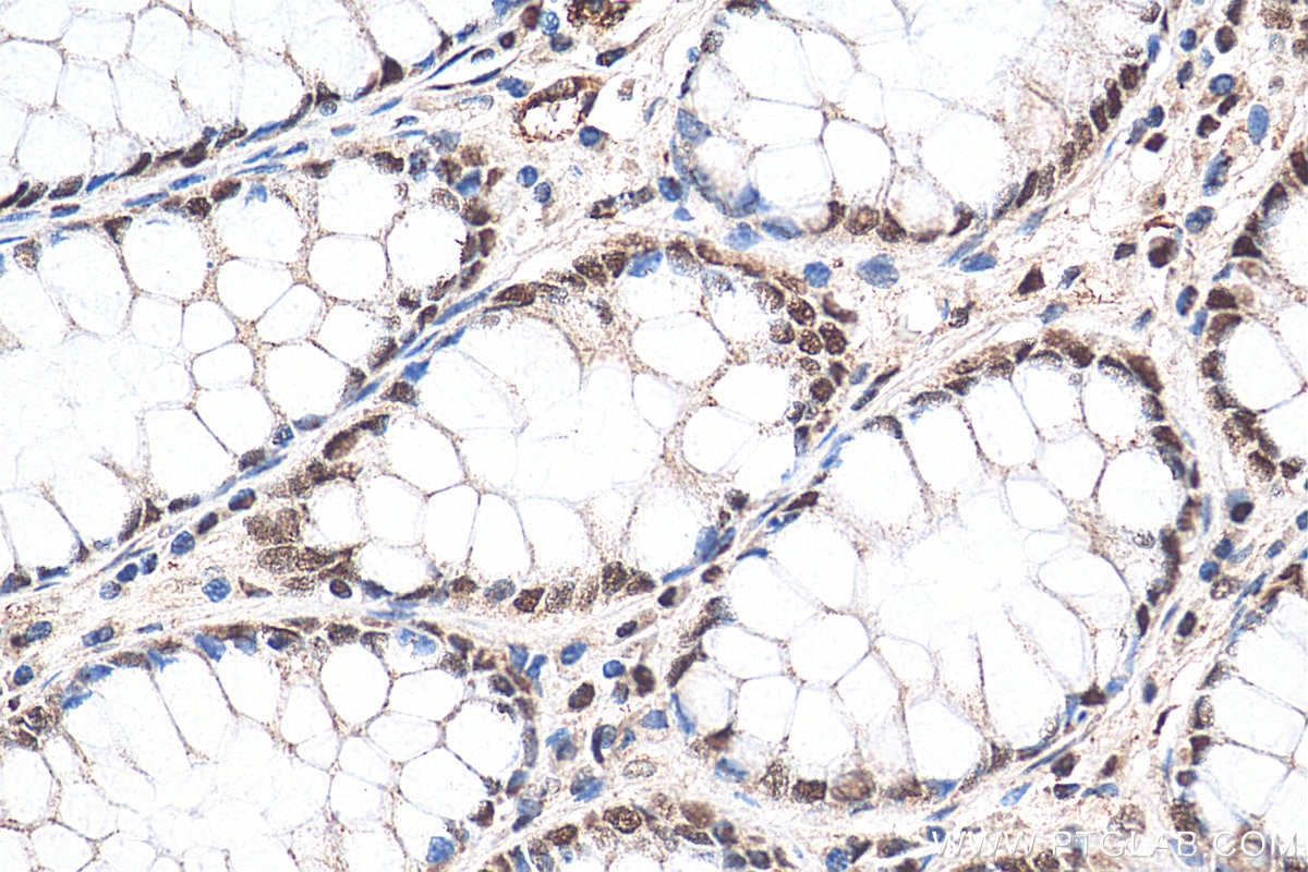 Immunohistochemistry (IHC) staining of human colon cancer tissue using DIS3 Polyclonal antibody (29664-1-AP)