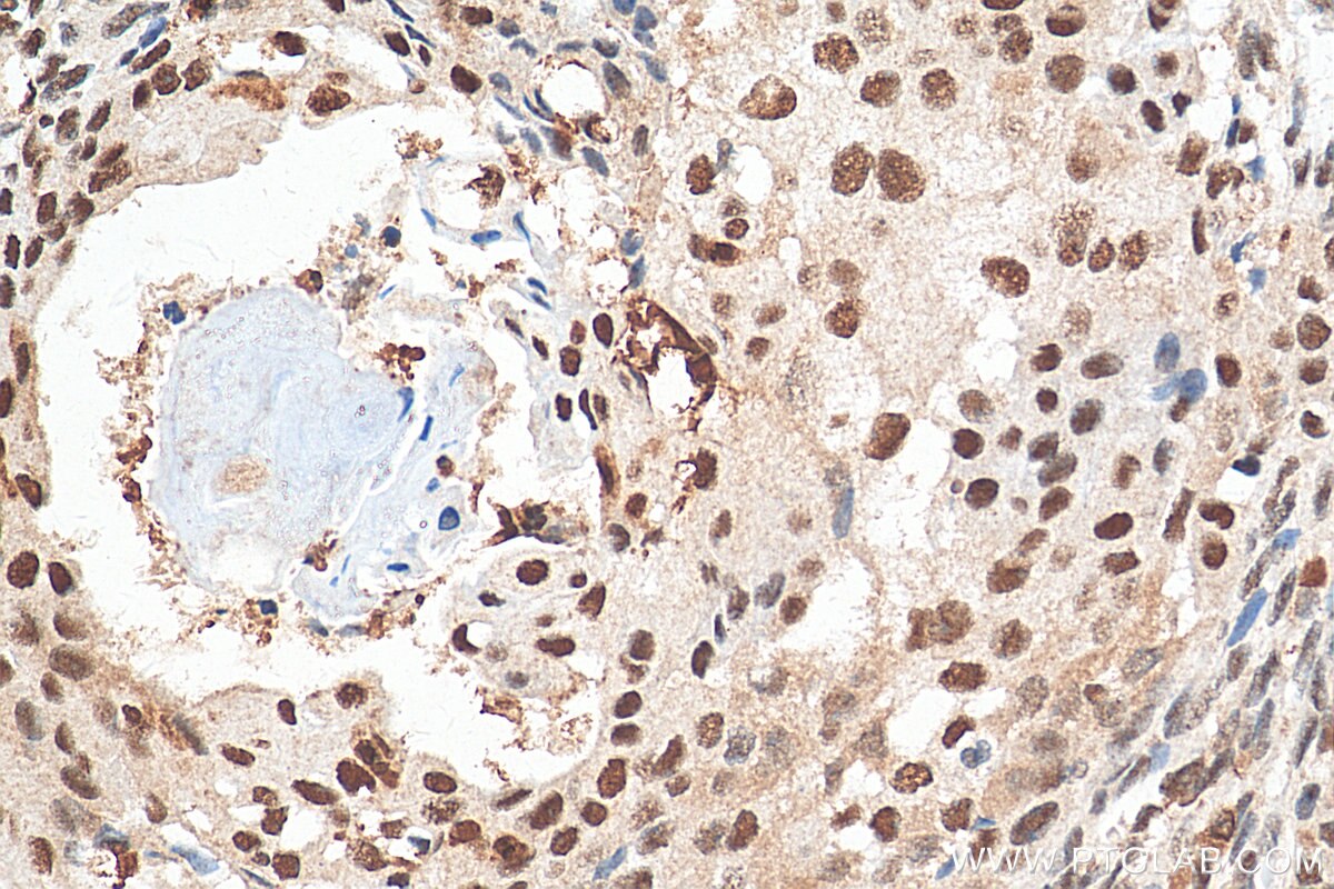 Immunohistochemistry (IHC) staining of human ovary tumor tissue using DIS3 Polyclonal antibody (29664-1-AP)