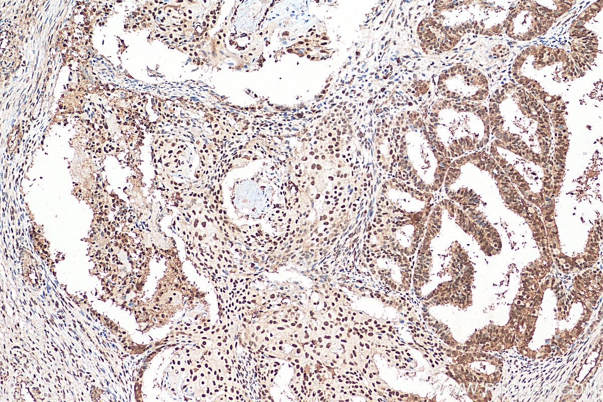 Immunohistochemistry (IHC) staining of human ovary tumor tissue using DIS3 Polyclonal antibody (29664-1-AP)