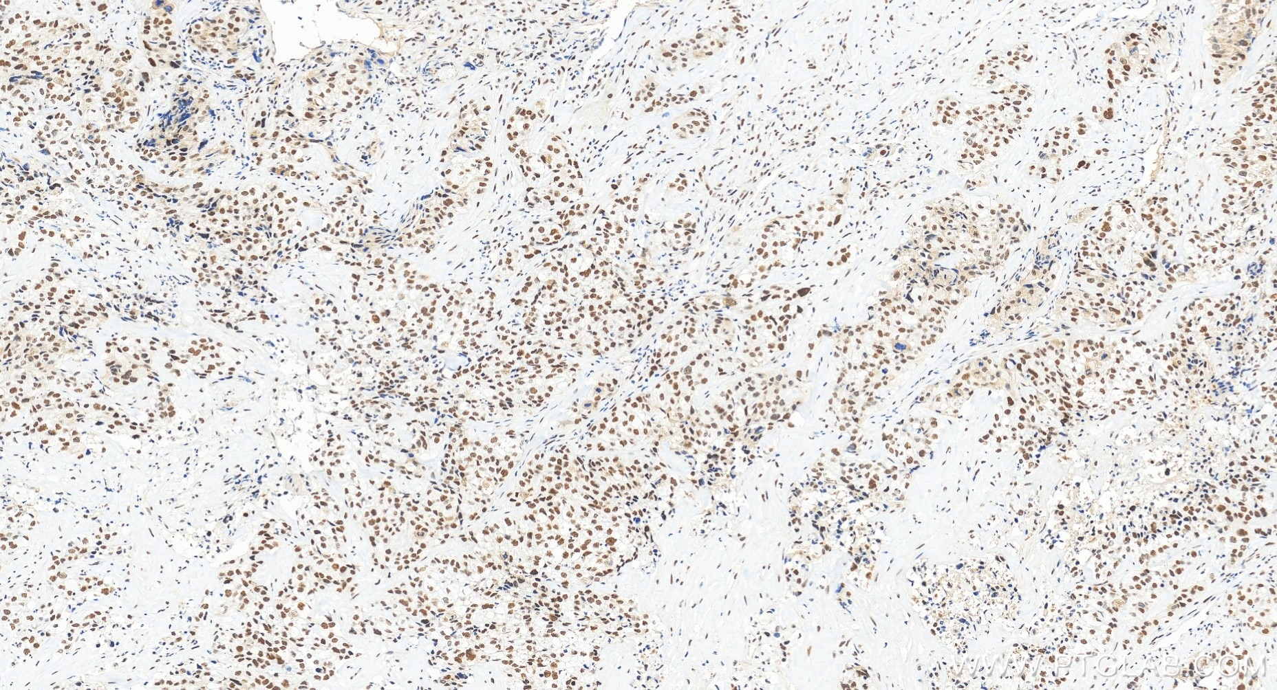 Immunohistochemical analysis of paraffin-embedded human ovary cancer tissue slide using 85705-2-RR (DIS3 antibody) at dilution of 1:500 (under 20x lens). Heat mediated antigen retrieval with Tris-EDTA buffer (pH 9.0). Immunohistochemistry (IHC) staining of human ovary cancer tissue using DIS3 Recombinant monoclonal antibody (85705-2-RR)