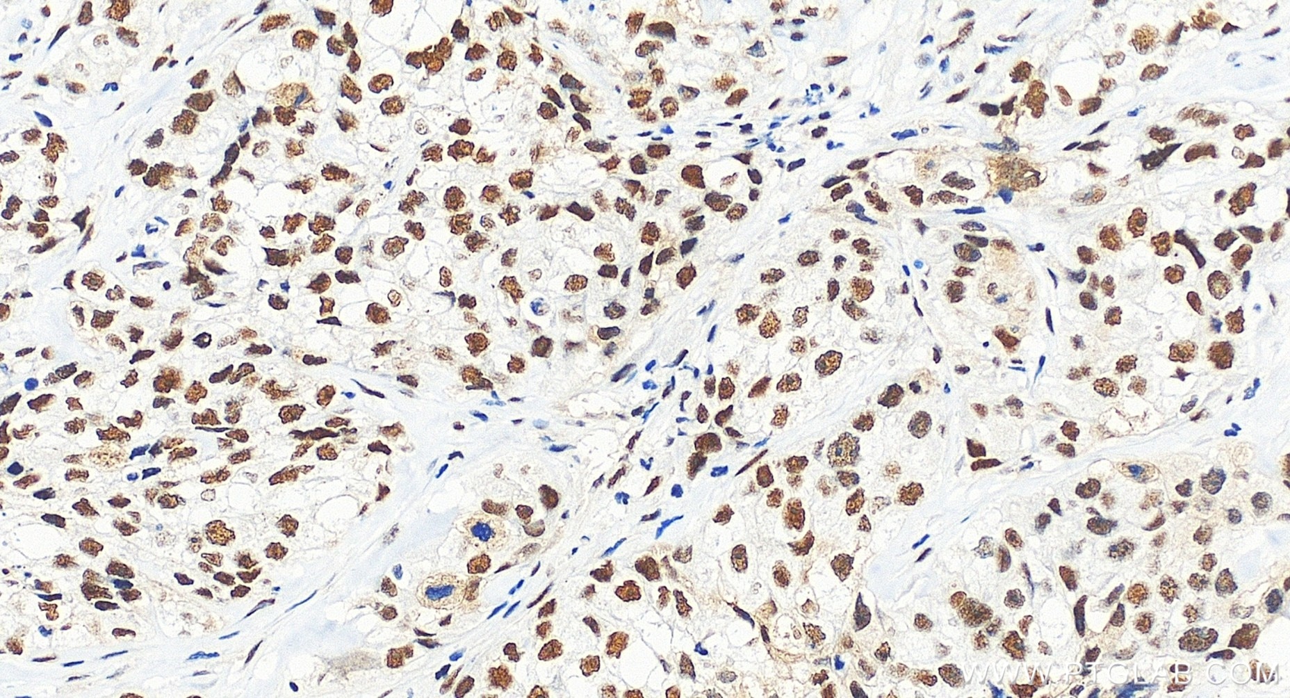 Immunohistochemical analysis of paraffin-embedded human ovary cancer tissue slide using 85705-2-RR (DIS3 antibody) at dilution of 1:500 (under 20x lens). Heat mediated antigen retrieval with Tris-EDTA buffer (pH 9.0). Immunohistochemistry (IHC) staining of human ovary cancer tissue using DIS3 Recombinant monoclonal antibody (85705-2-RR)