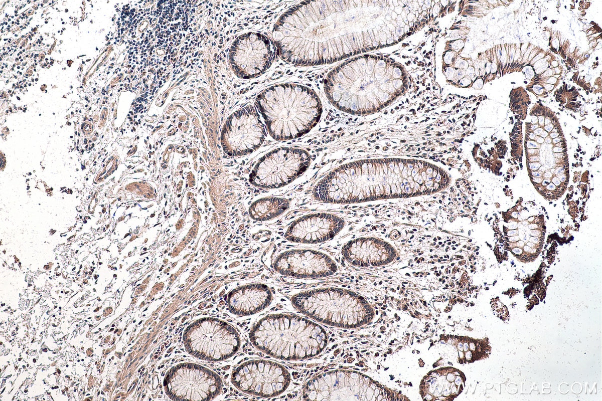 IHC staining of human colon cancer using 25420-1-AP
