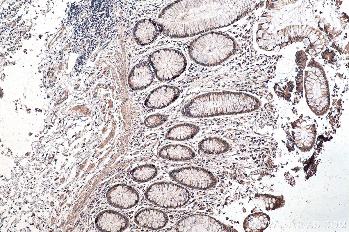 Immunohistochemistry (IHC) staining of human colon cancer tissue using DKC1 Polyclonal antibody (25420-1-AP)