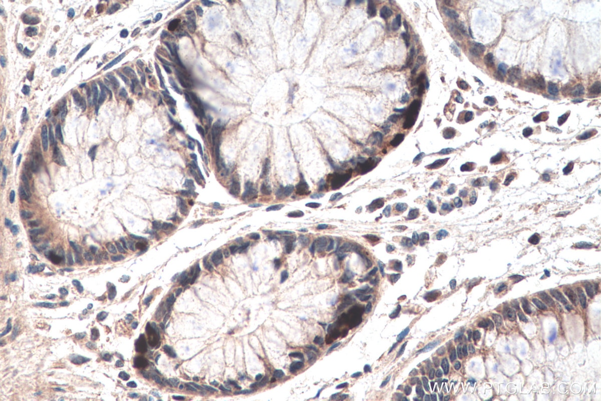 Immunohistochemistry (IHC) staining of human colon cancer tissue using DKC1 Polyclonal antibody (25420-1-AP)