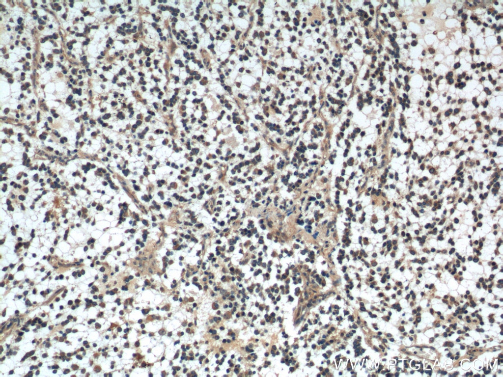 Immunohistochemistry (IHC) staining of human gliomas tissue using DKK1 Polyclonal antibody (21112-1-AP)