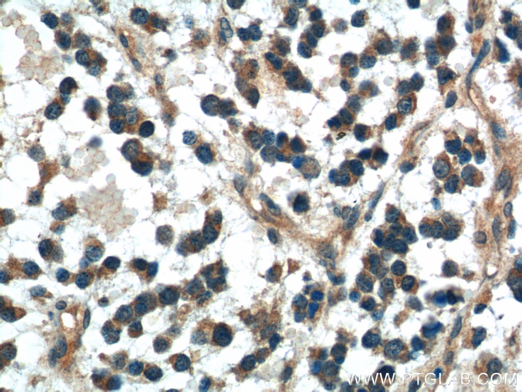 IHC staining of human gliomas using 21112-1-AP