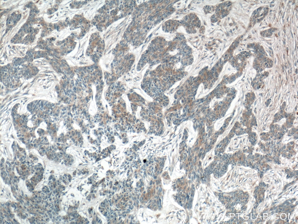 IHC staining of human skin cancer using 21051-1-AP