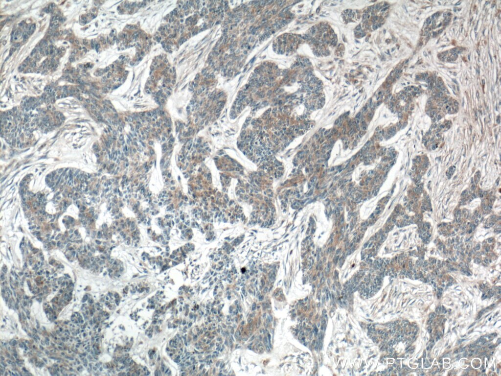 Immunohistochemistry (IHC) staining of human skin cancer tissue using DKK2 Polyclonal antibody (21051-1-AP)