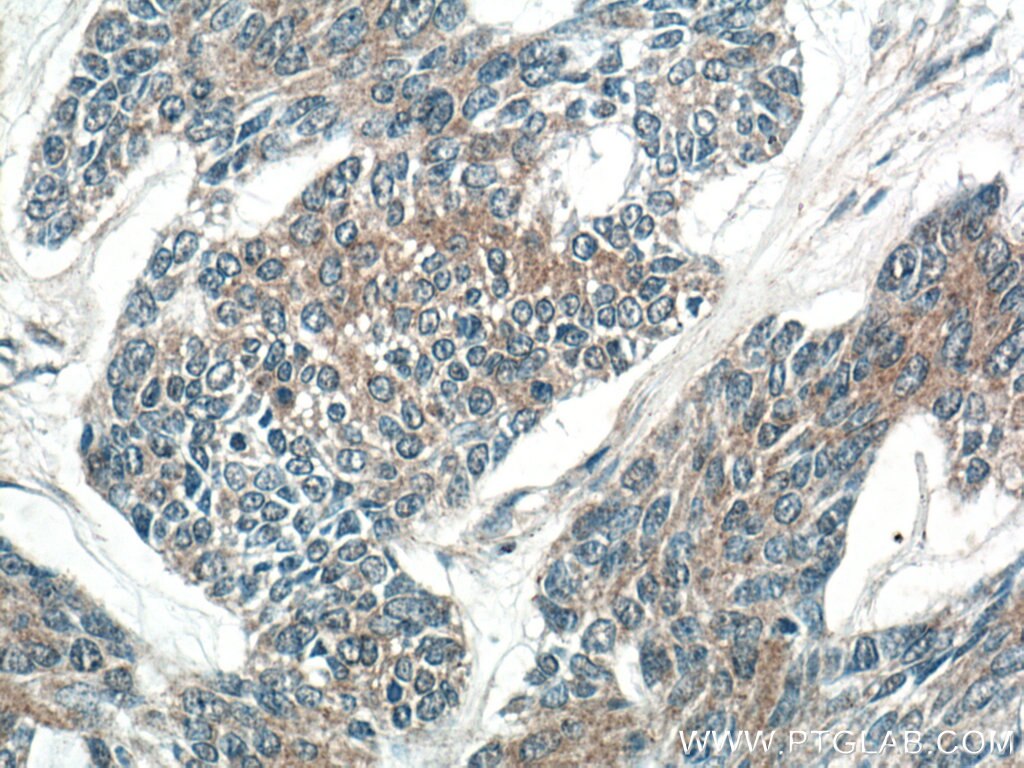 Immunohistochemistry (IHC) staining of human skin cancer tissue using DKK2 Polyclonal antibody (21051-1-AP)
